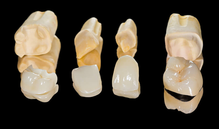 dental crowns in nw calgary